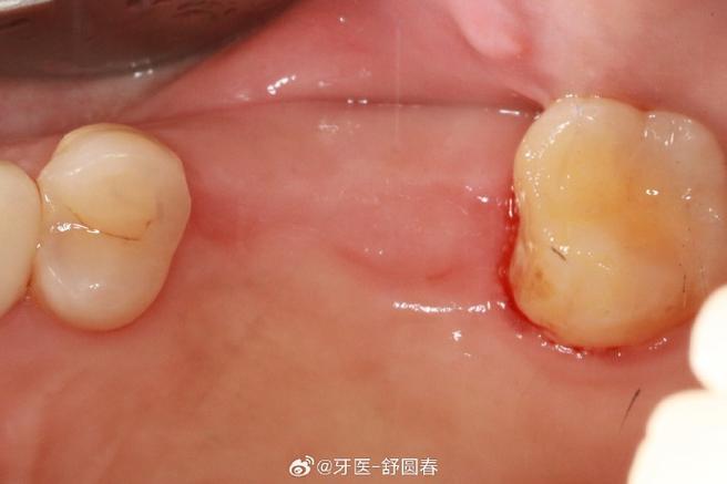 種植即刻修復(fù) 舒醫(yī)生的診療日常與醫(yī)學(xué)匠心